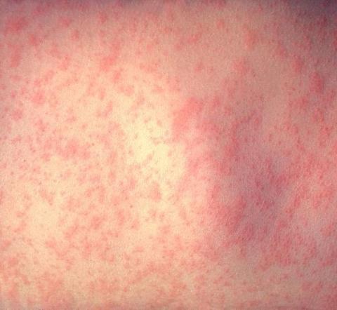 Measles outbreak prompts PHA to issue vaccination warning